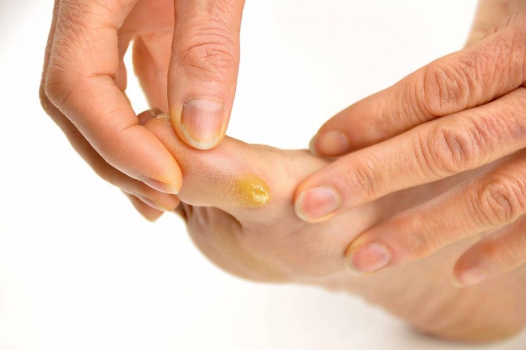 5 Callus Removal Mistakes to Avoid