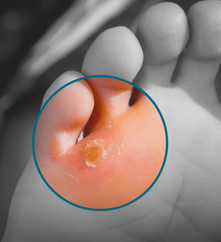 Callus Removal Mistakes to Avoid