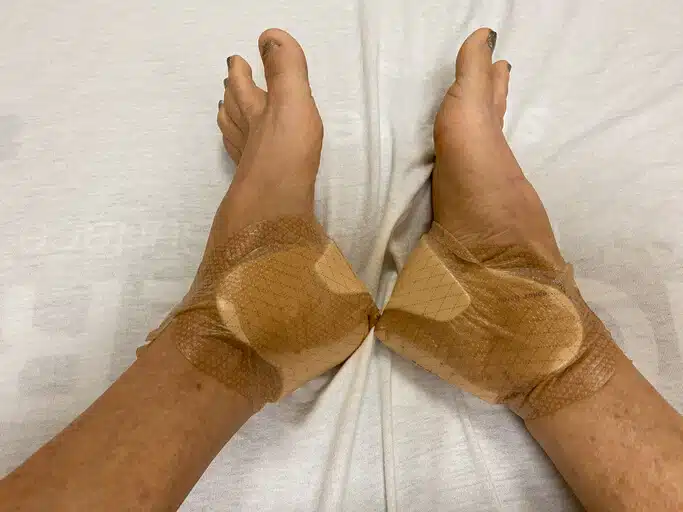 After Foot Surgery