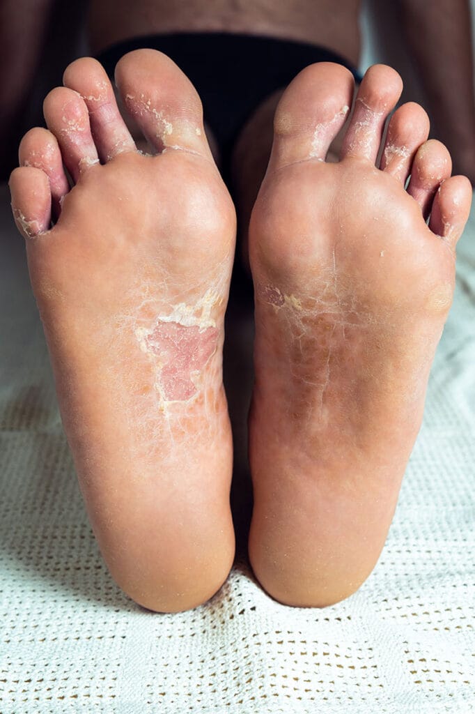 Foot Care for Skin Conditions 