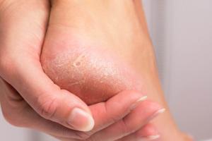 Causes of Callus