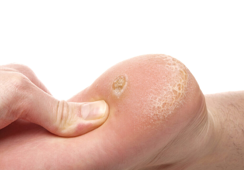 Causes of Callus