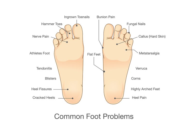 Common Foot Problems