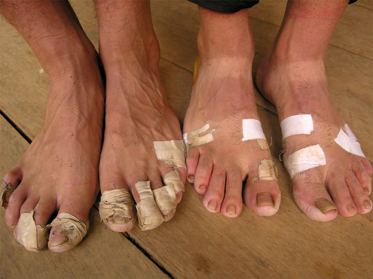 Foot Care for Runners