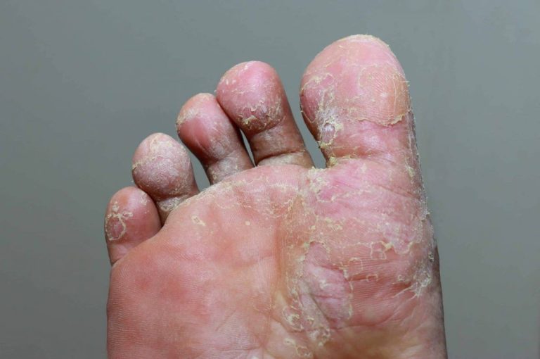 Foot Fungal Infections