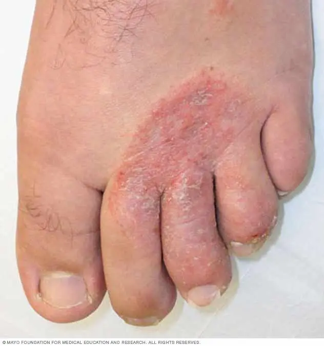 Foot Fungal Infections