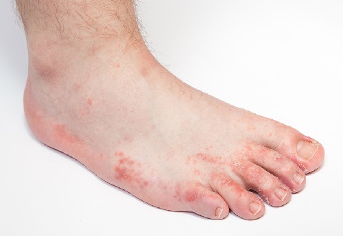 Foot Fungal Infections