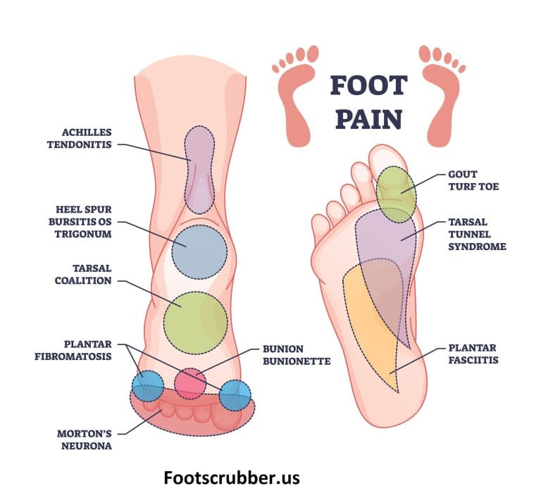 Foot Pain Chart