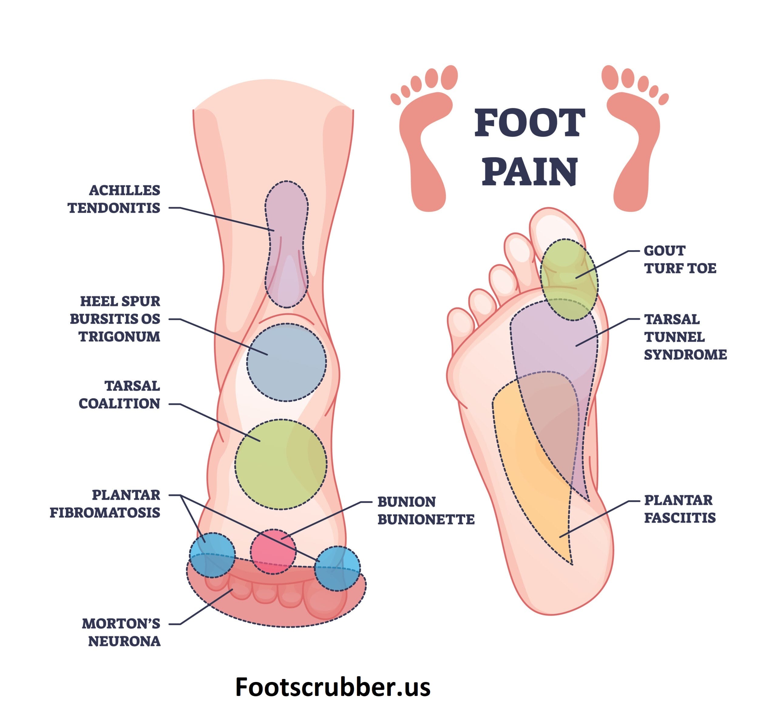 Foot Pain Chart