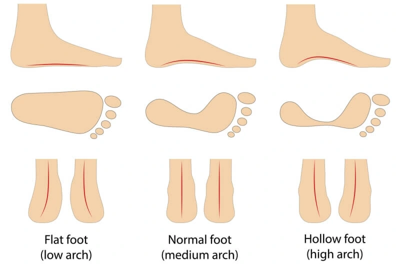 Foot Type