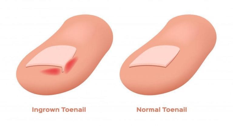 Ingrown Toenail