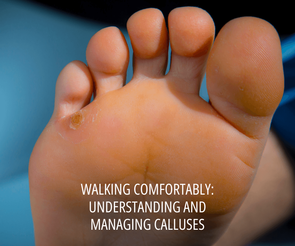 Managing Foot Calluses