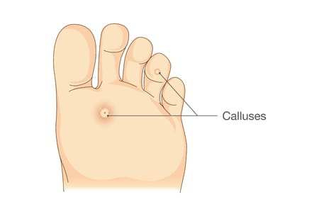 Managing Foot Calluses