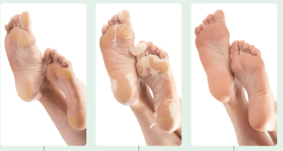 Science of foot Exfoliation