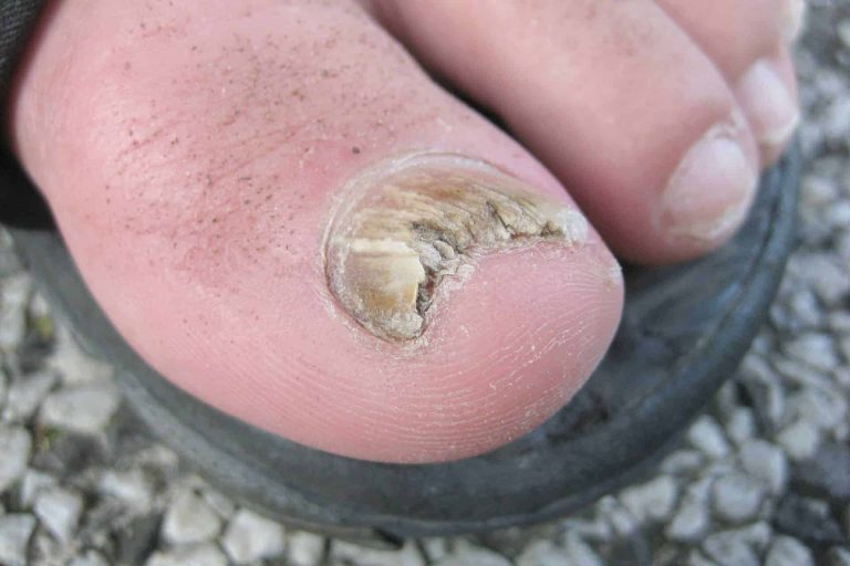 Toenail Issues