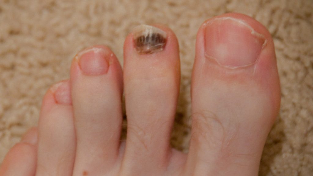 Toenail Issues