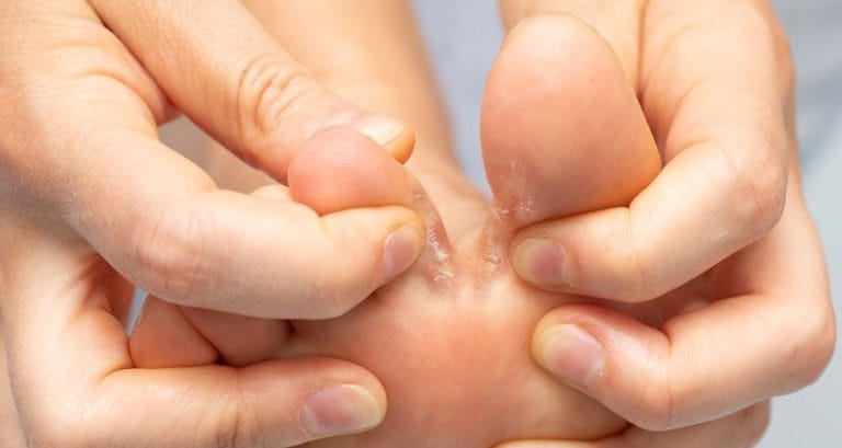 Athlete's Foot Care: 7 Expert Tips for Prevention and Treatment