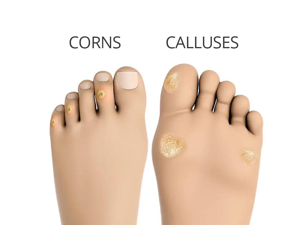 Causes of Callus