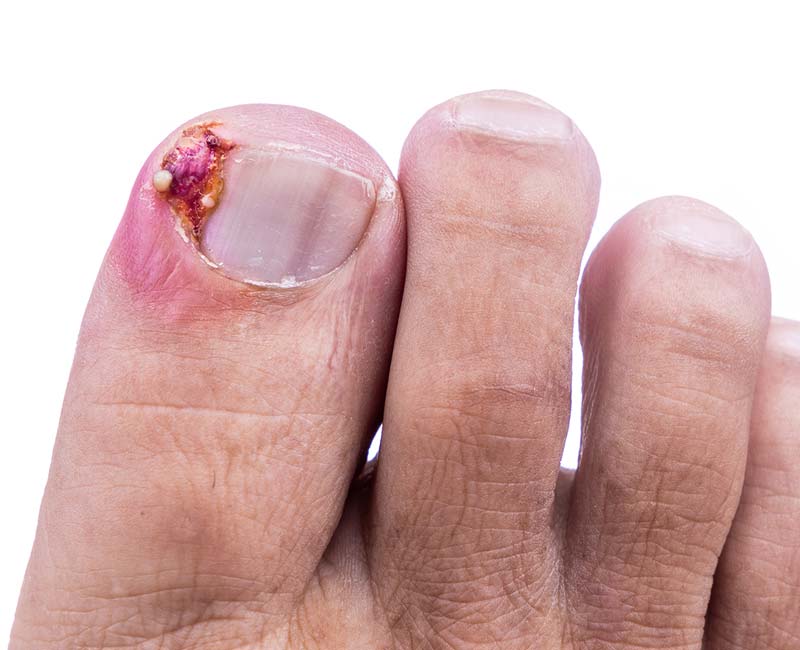 Ingrown Toenail