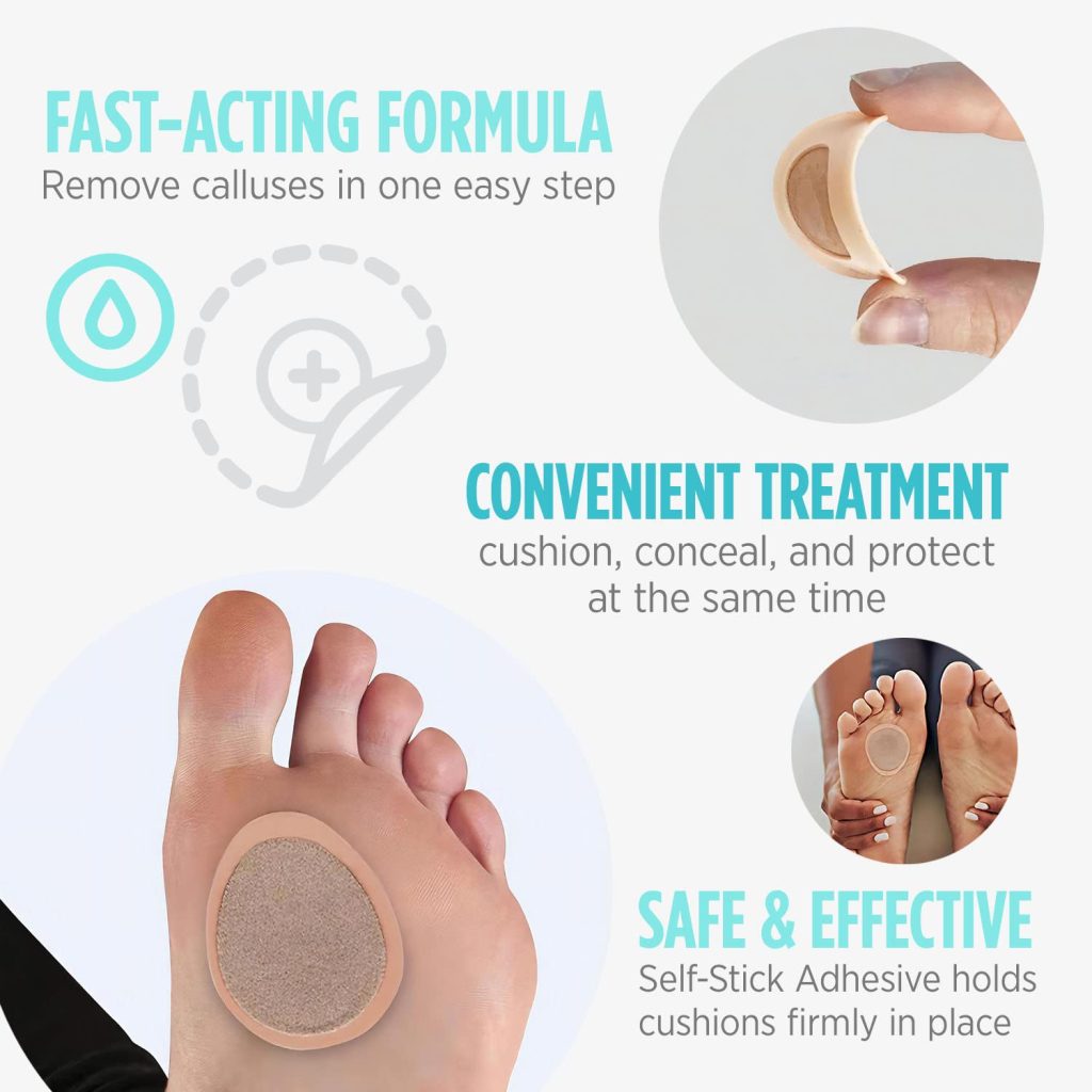 Callus Removal Remedies