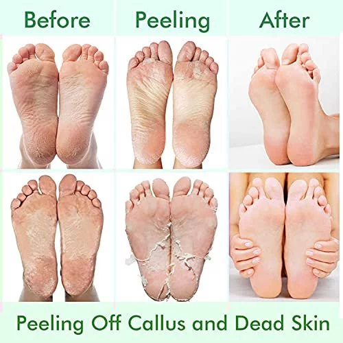 Calluses and Dead Skin: