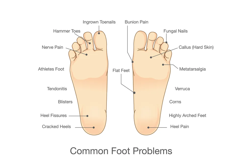 Common Foot Problems and Conditions