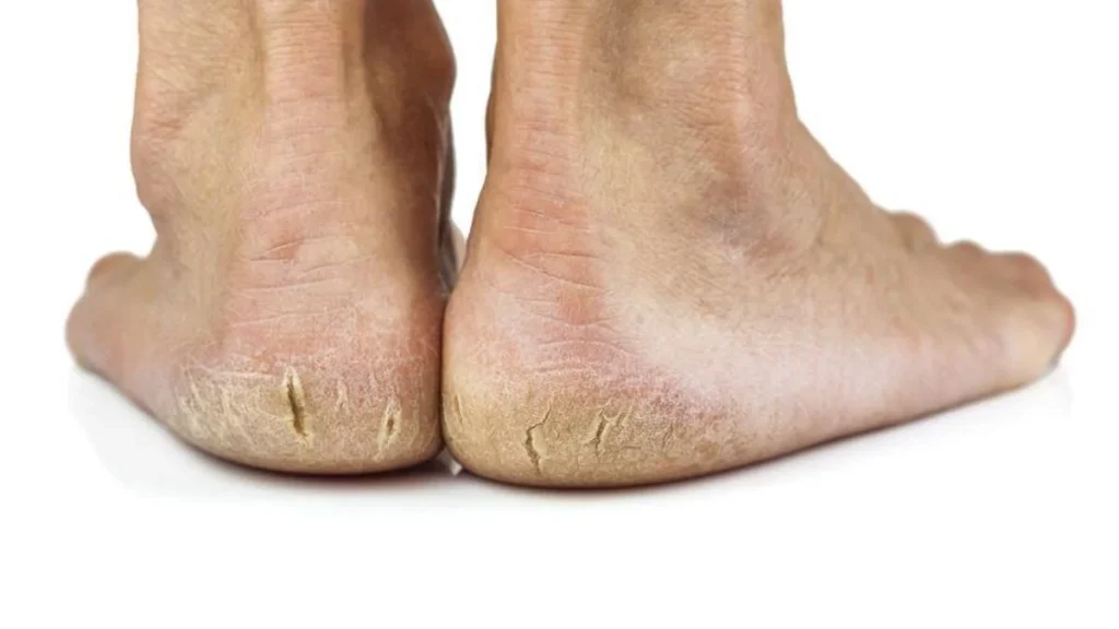 Causes of Dead Skin on Feet / foot Buffing