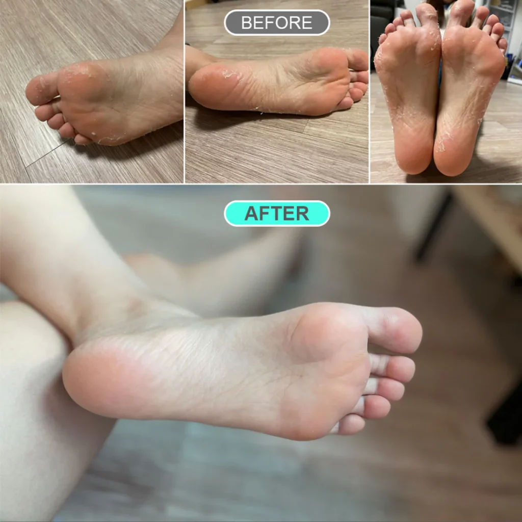 Foot Mask Treatments